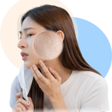 Trị Sẹo Rỗ